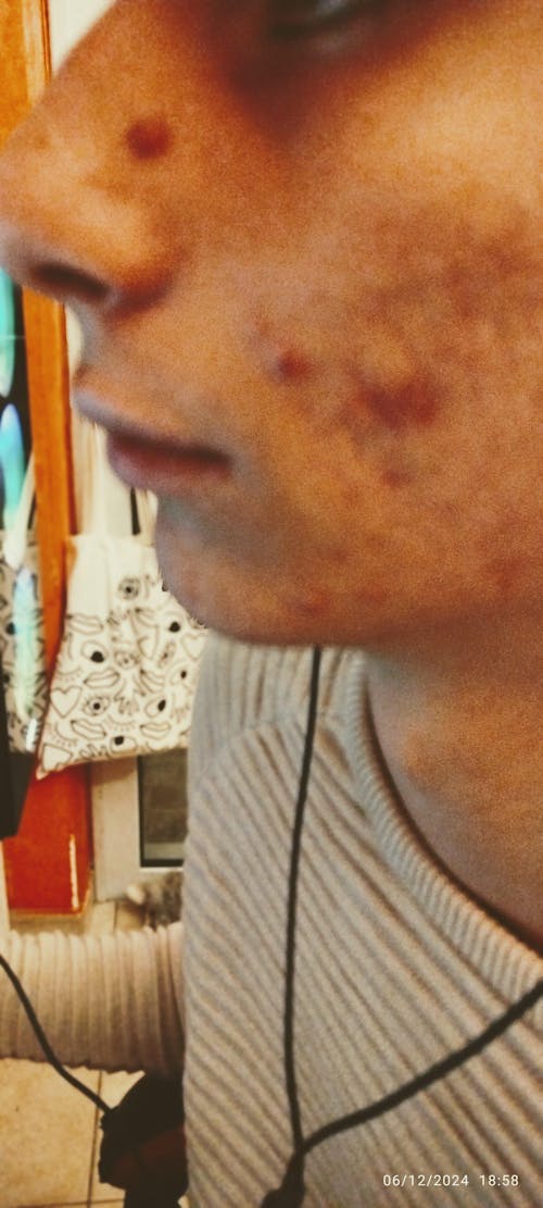 Οργανικό νερό Λεβάντας - Hydrolina για την Ακμή