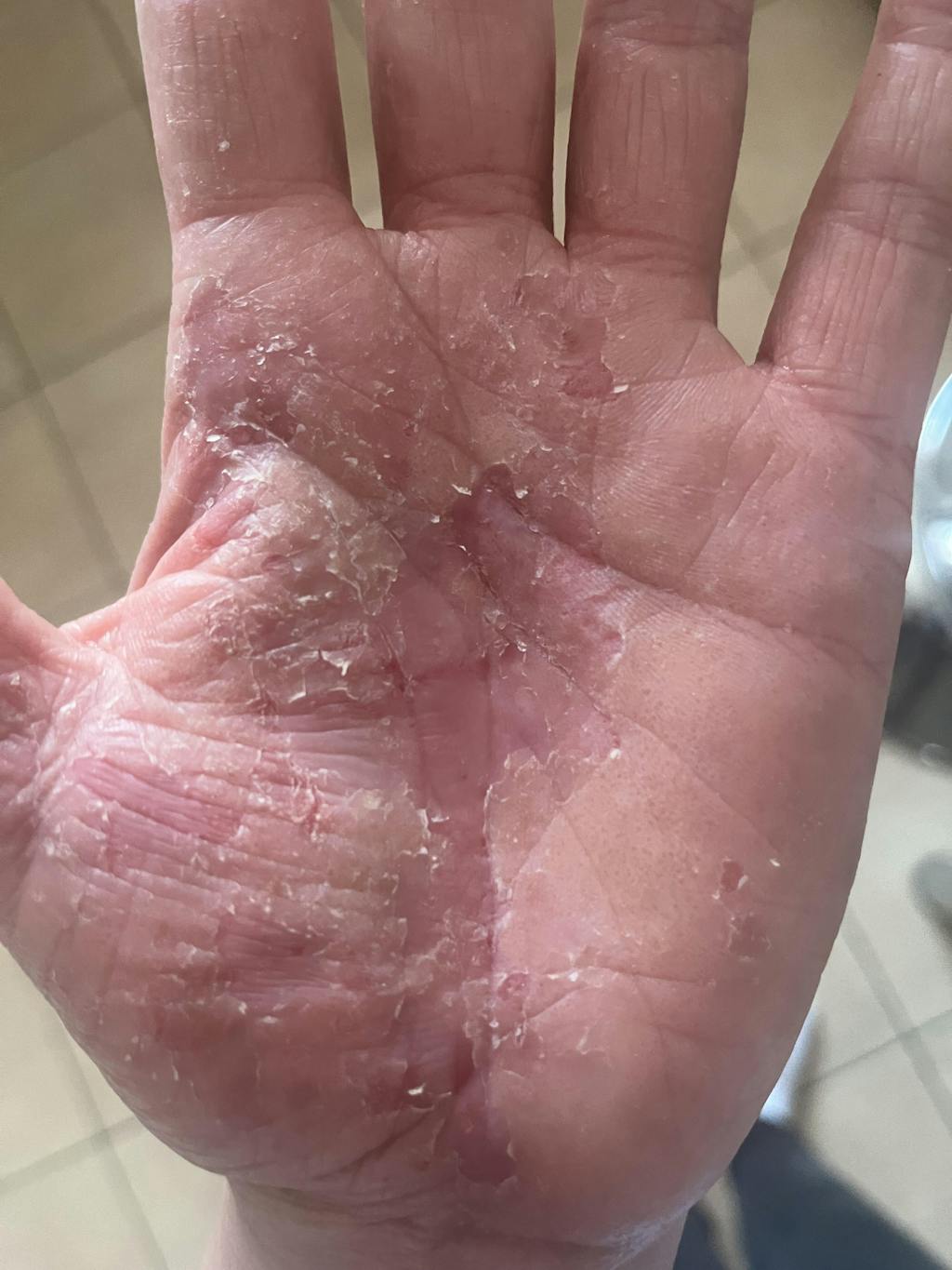 Ekzem RoutINA™ - dauerhafte Lösung für Ekzeme und Hautirritationen