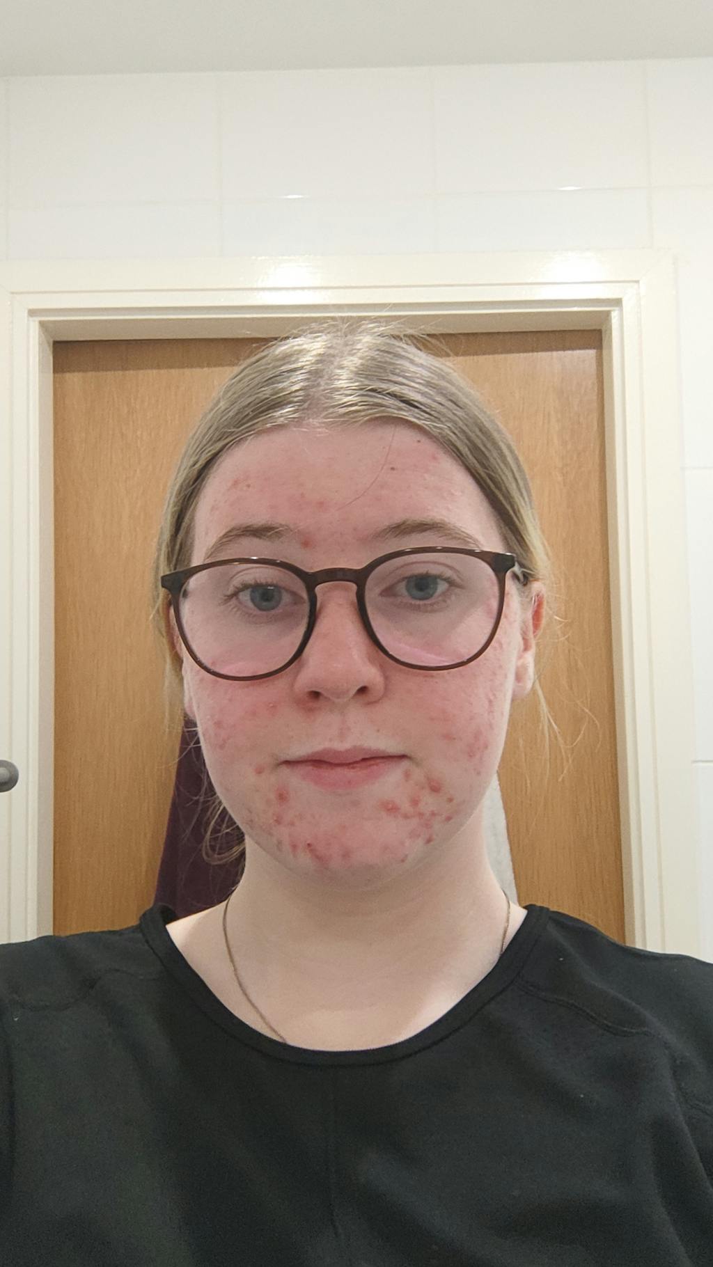 Organic Lavender water - Hydrolina for Acne