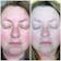 RosaLight™ - The Rosacea and Couperose Phototherapy Mask