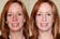 RosaLight™ - The Rosacea and Couperose Phototherapy Mask