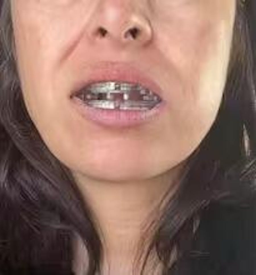 Protège-Dents Anti-Ronflement et Anti-Bruxisme