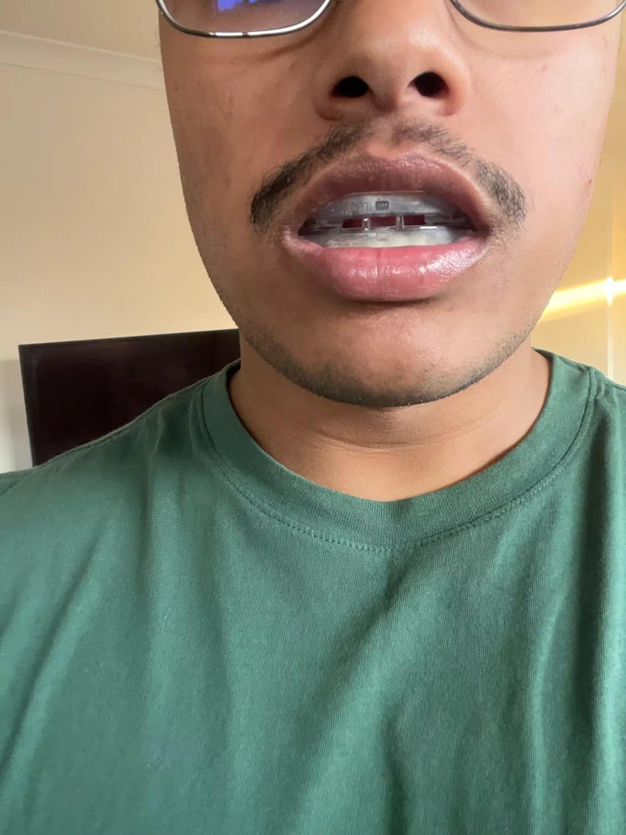 Protège-Dents Anti-Ronflement et Anti-Bruxisme