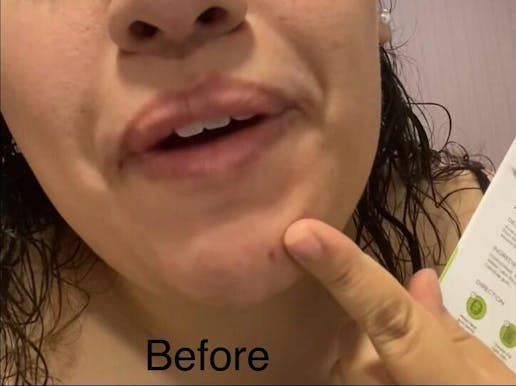 36 Acne Patches Day/Night Time