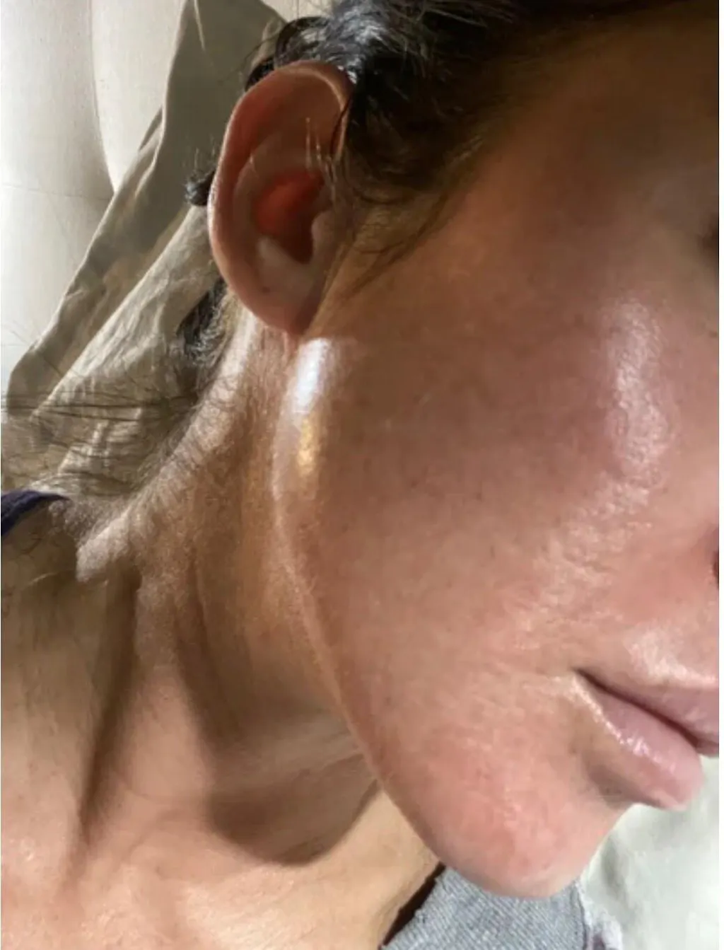 Pinxel VS RF Microneedling with Vacuum Air Chamber Skin Care Beauty Machine