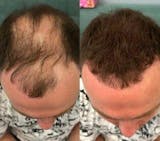 Relleno de densidad capilar