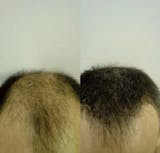 Relleno de densidad capilar