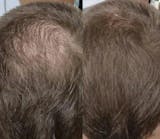 Relleno de densidad capilar