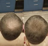 Relleno de densidad capilar