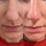 Peel Shot Coréen - Élimine les Impuretés et Sublime Votre Peau