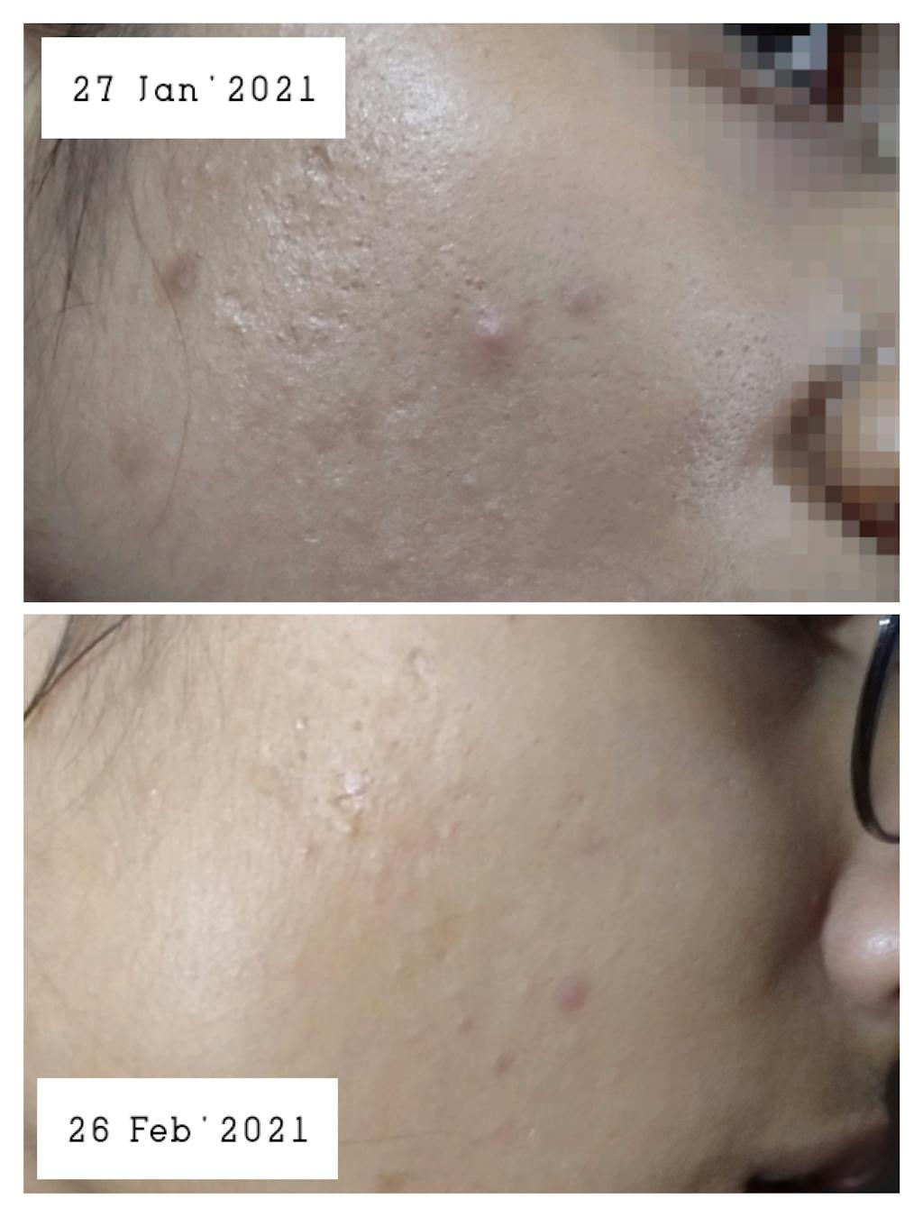 Salicylic Acid 2 Fights Breakout & Blackheads. Reduces Open Pores