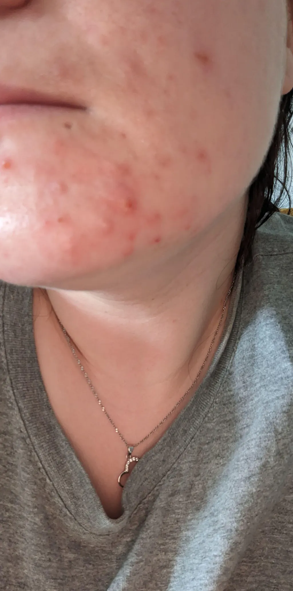 Monday Muse Clarity Complex Hormonal Acne Supplement