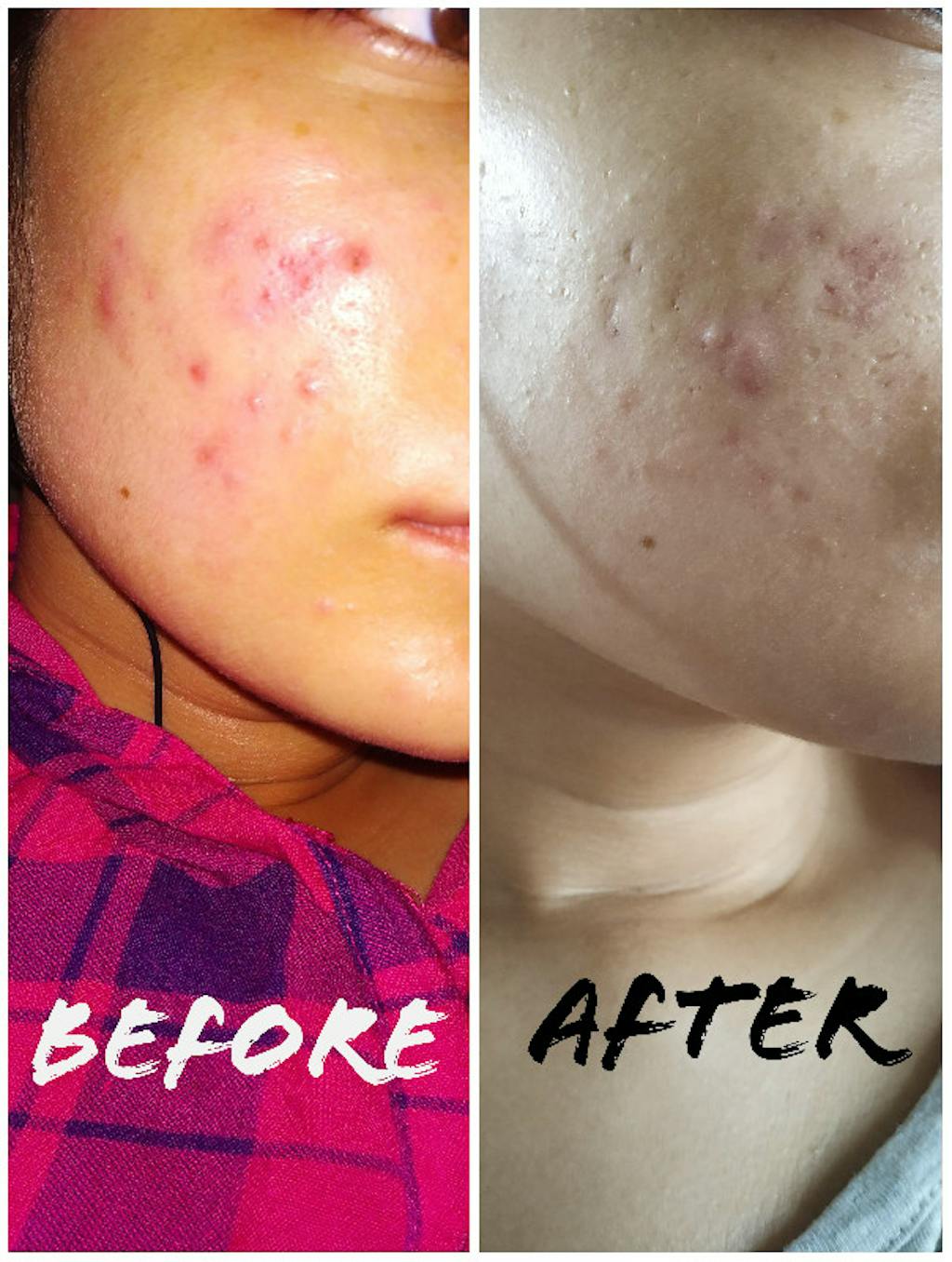 Tea Tree Face Gel Best Oily Skin Cream For Acne & Pimple Removal