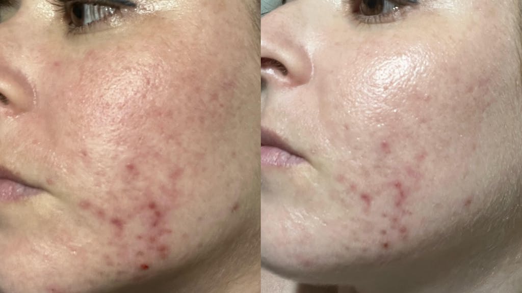 Tratamiento Manchas Rojizas I Pie Acne Treatment I Transparent Lab