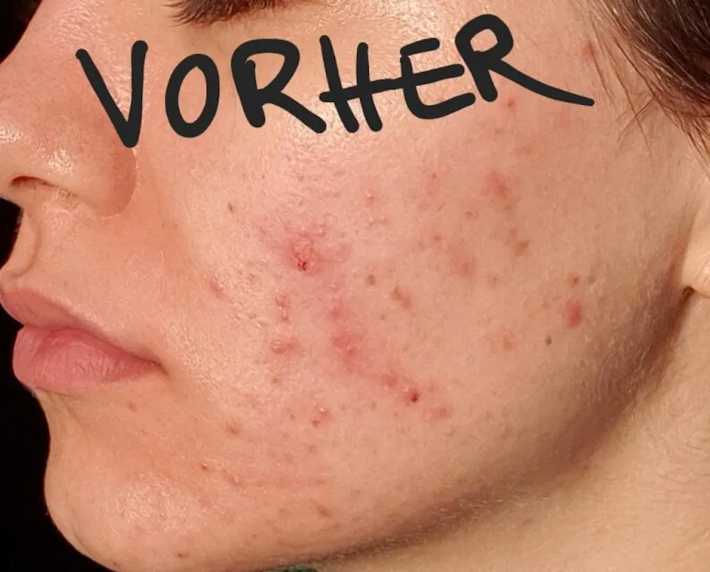 15% Azelaic Acid Treatment I AZID I Theramid – NICHE BEAUTY LAB