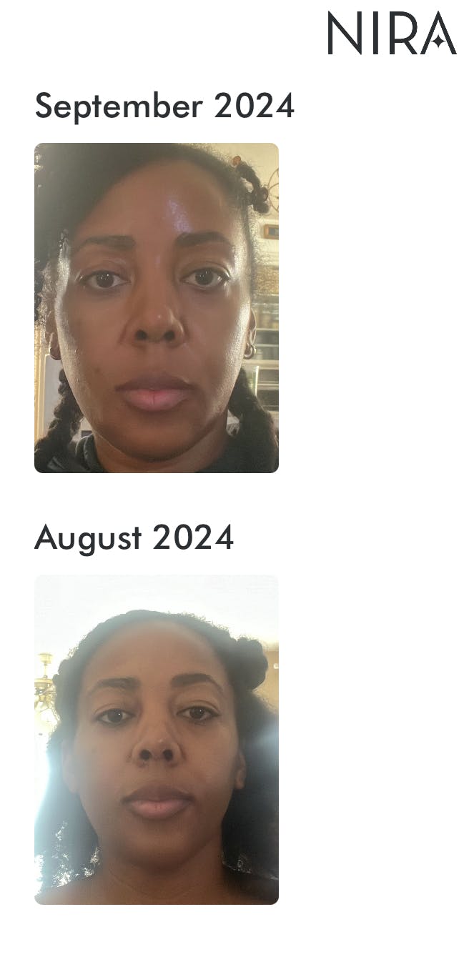 NIRA Pro Laser | At-Home Laser Device for Full Wrinkle Reduction