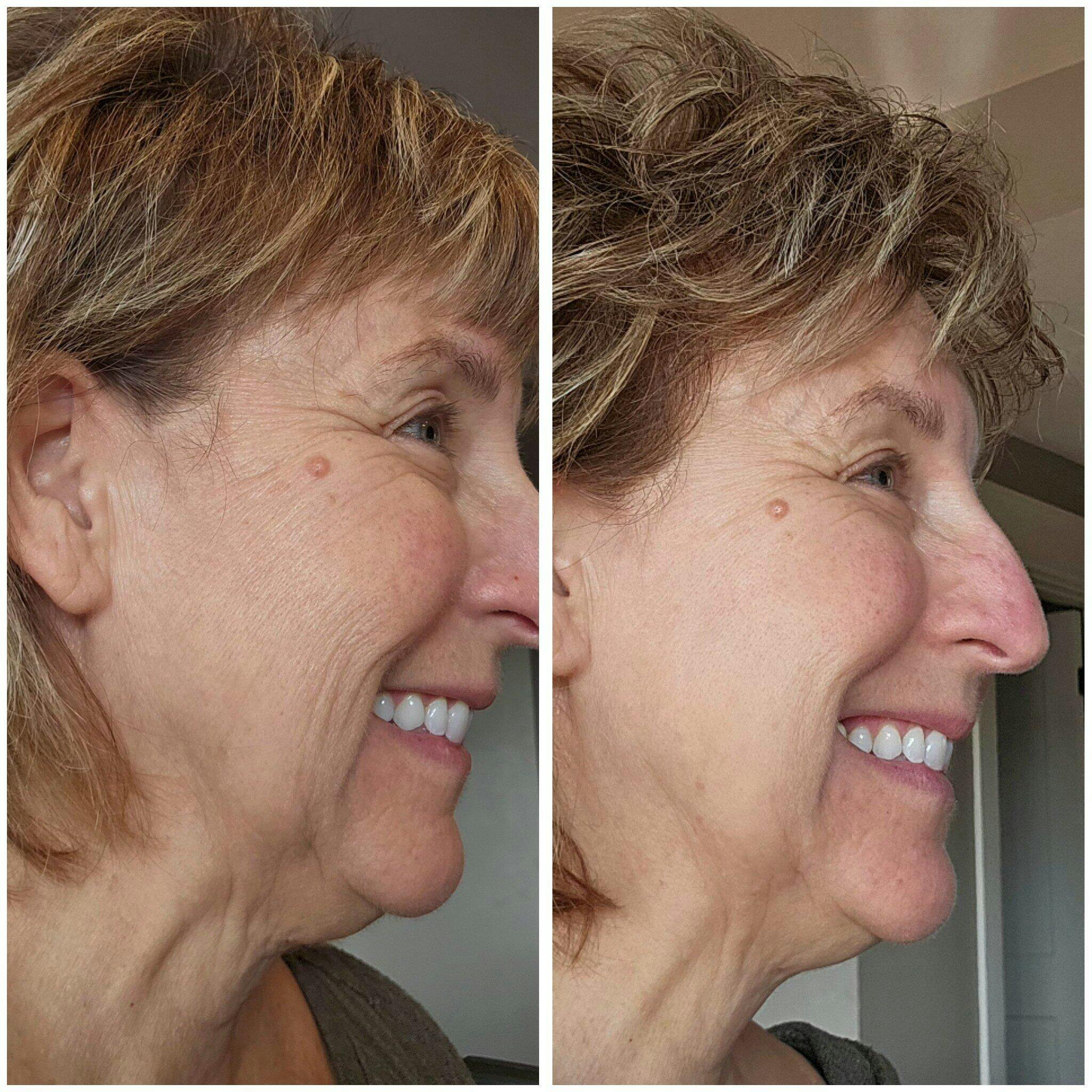 NIRA Ultimate Bundle+ | Complete At-Home Anti-Aging System