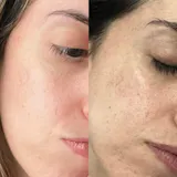 RUTINA AM&PM - GRANITOS + MARCAS + POROS + MANCHAS + ARRUGAS