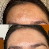 RUTINA AM&PM - GRANITOS + MARCAS + POROS + MANCHAS + ARRUGAS