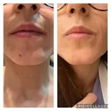 KIT TRATAMIENTO - MANCHAS + GRANITOS + IMPERFECCIONES