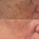 RUTINA AM&PM - GRANITOS + MARCAS + POROS + MANCHAS + ARRUGAS