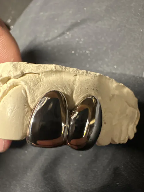 2-Tooth Dental Silver Caps | Custom Grillz UK | Onyx Grillz
