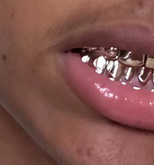 2-Tooth Dental Silver Caps | Custom Grillz UK | Onyx Grillz
