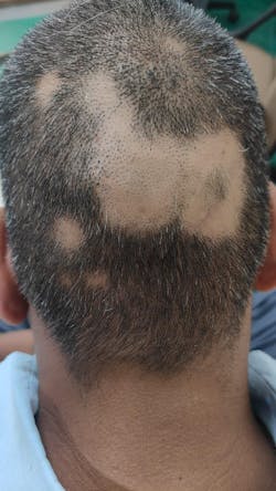 Advanced Formula For Alopecia Treatment - (100% Result)