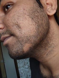 Advanced Formula For Alopecia Treatment - (100% Result)