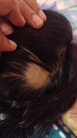 Advanced Formula For Alopecia Treatment - (100% Result)