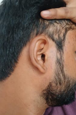 Advanced Formula For Alopecia Treatment - (100% Result)