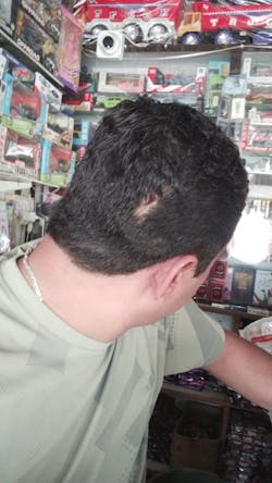 Advanced Formula For Alopecia Treatment - (100% Result)