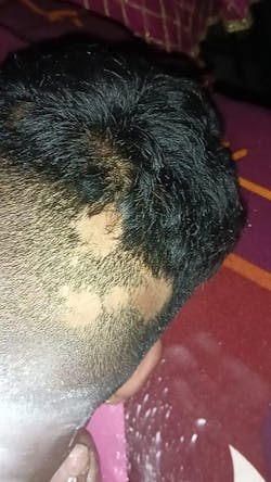 Advanced Formula For Alopecia Treatment - (100% Result)