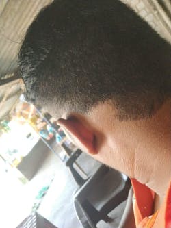 Advanced Formula For Alopecia Treatment - (100% Result)