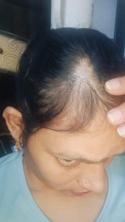 Advanced Formula For Alopecia Treatment - (100% Result)