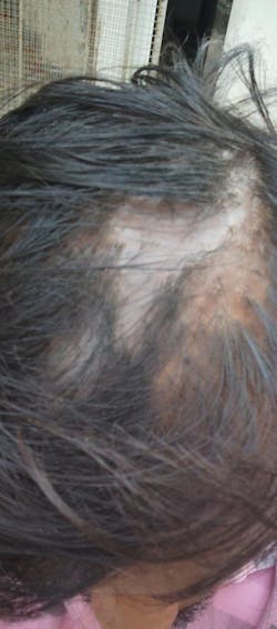 Advanced Formula For Alopecia Treatment - (100% Result)