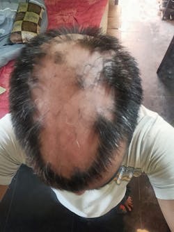 Advanced Formula For Alopecia Treatment - (100% Result)