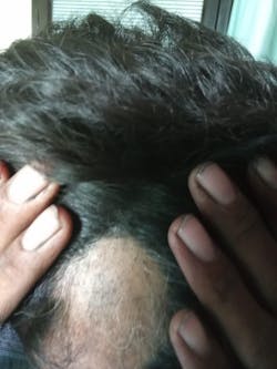 Advanced Formula For Alopecia Treatment - (100% Result)