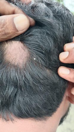 Advanced Formula For Alopecia Treatment - (100% Result)