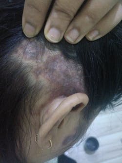 Advanced Formula For Alopecia Treatment - (100% Result)