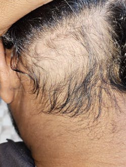 Advanced Formula For Alopecia Treatment - (100% Result)