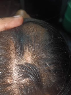 Advanced Formula For Alopecia Treatment - (100% Result)