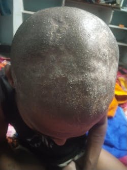 Advanced Formula For Alopecia Treatment - (100% Result)