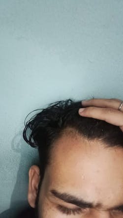 Advanced Formula For Alopecia Treatment - (100% Result)