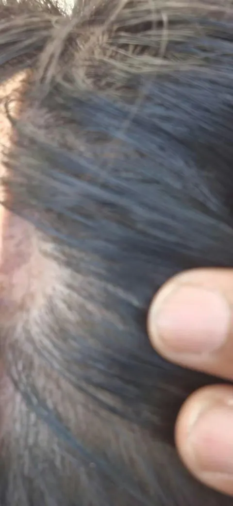 Alopecia Hair Patch Oil with Roller  - Advanced Formula for Alopecia Areata Treatment