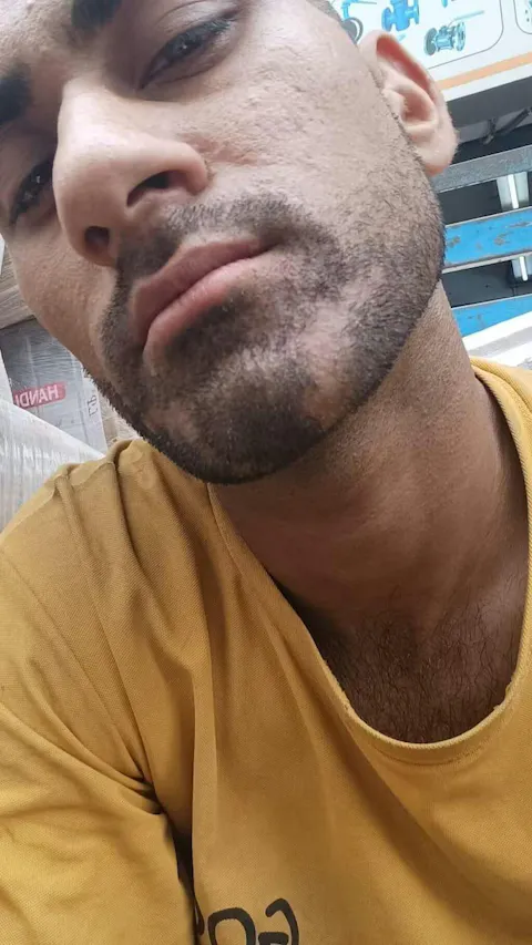 Alopecia Hair Patch Oil with Roller  - Advanced Formula for Alopecia Areata Treatment