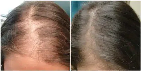 Advanced Ayurvedic Formula for Alopecia Treatment | Doctor Recommended | 100% Safe & Effective