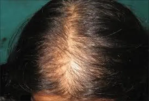 Advanced Ayurvedic Formula for Alopecia Treatment | Doctor Recommended | 100% Safe & Effective