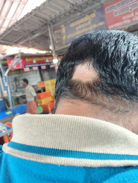 Advanced Ayurvedic Formula for Alopecia Treatment | Doctor Recommended | 100% Safe & Effective