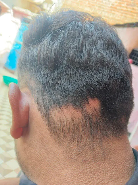 Advanced Ayurvedic Formula for Alopecia Treatment | Doctor Recommended | 100% Safe & Effective